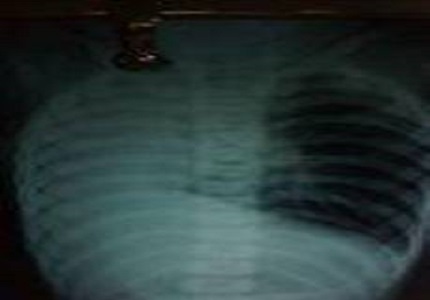 Unilateral Lung Aplasia Presenting with Acute Respiratory Distress Possibly due to milk aspiration in Young Toddler