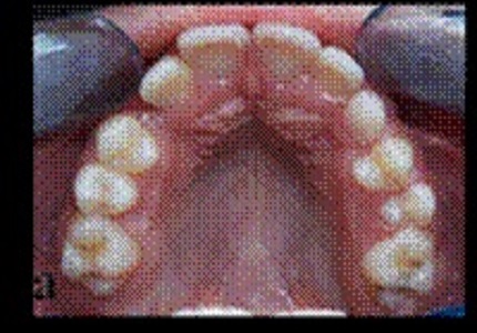 Management of space in the mixed dentition: The use of lip bumper