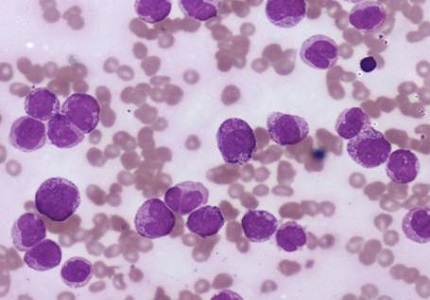Co existence of acute promyelocytic leukemia and autoimmune haemolytic anaemia in a girl – A diagnostic and therapeutic challenge