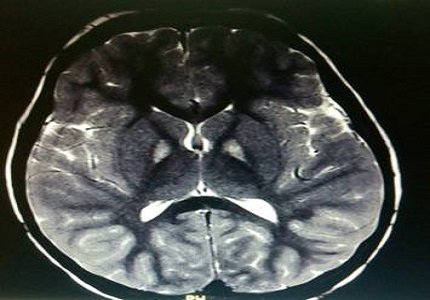 Hallervorden Spatz disease (Pantothenate Kinase associated Neurodegeneration): a rare case report