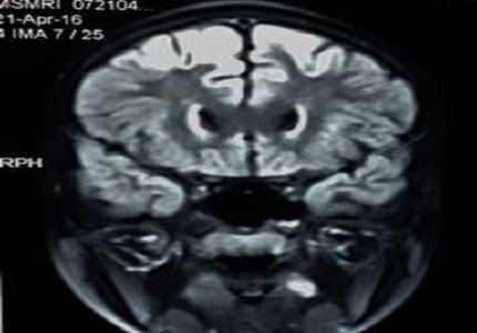 Neuro Wilson disease in an adolescent girl – early presentation- a case report