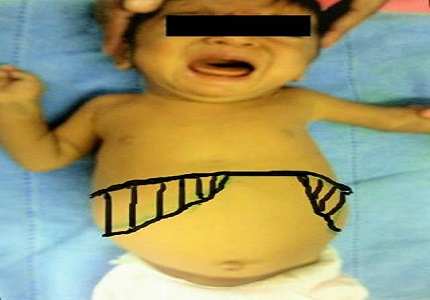 Extra-Hepatic portal venous obstruction with portal biliopathy in infant presenting as neonatal cholestasis: a rare case report and review of literature