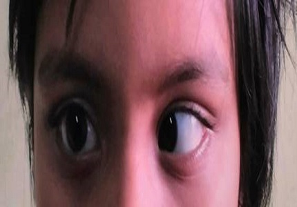 Benign isolated sixth nerve palsy in a child- a case report