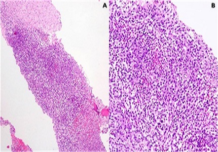 Langerhans cell sarcoma presenting as a mediastinal mass in a young infant: a case report