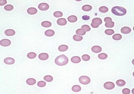 A case report of hereditary spherocytosis affecting mother and child with varied severity