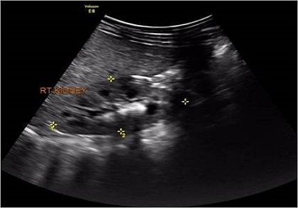 Urolithiasis in a child with acute lymphoblastic leukemia - a case report and review of literature