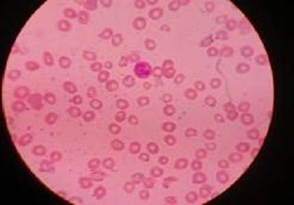 Megaloblastic anemia with pancytopenia in infancy:a rare entity