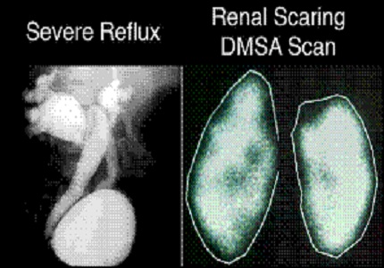 Study of 99 m-Tc DMSA (Dimercaptosuccinicacid) Scintigraphy in children with urinary tract infection