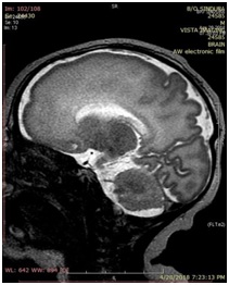 Lissencephaly– a rare cause of neonatal seizures