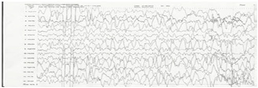 Abdominal epilepsy- A diagnosis often missed! - A case report