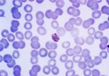 Congenital plasmodium vivax malaria mimicking neonatal sepsis: a case report