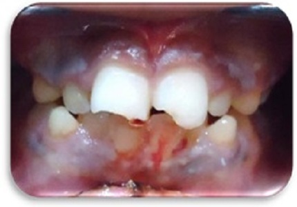 Tooth fragment lodged in the lower lip after traumatic dental: a case report