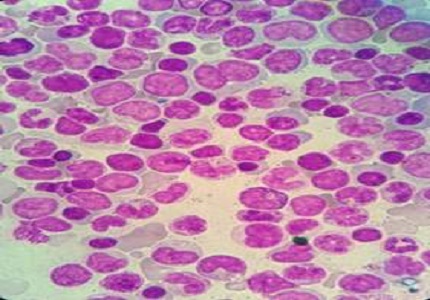 A case study report of denovo lymph node occurance of myeloid sarcoma