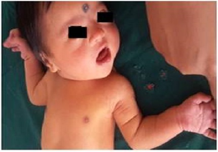Cholelithiasis in a neonate with Downs syndrome: a case report